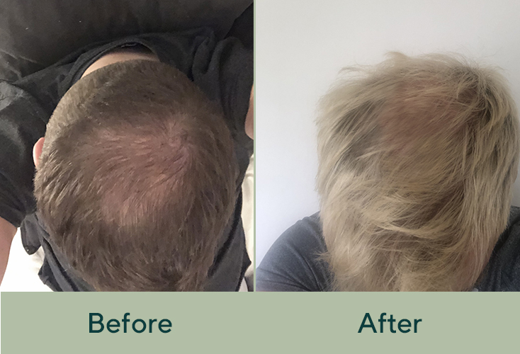 Joe Before & After Finasteride